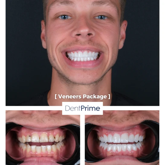 DentPrime before after case 1