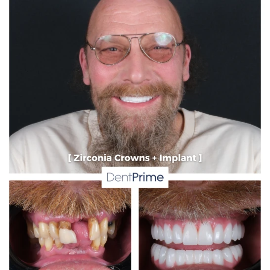 DentPrime before after case 10