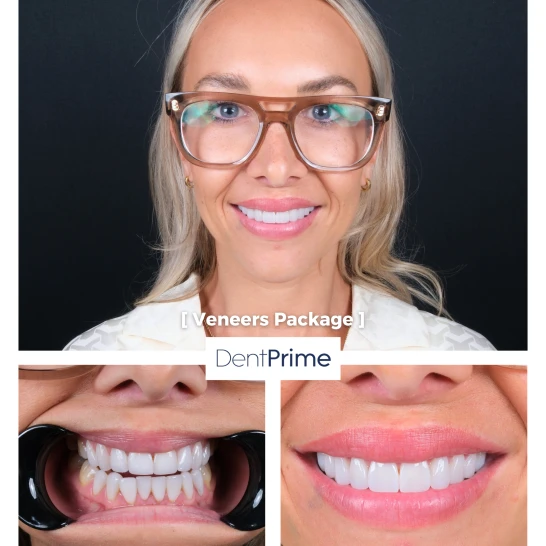 DentPrime before after case 11