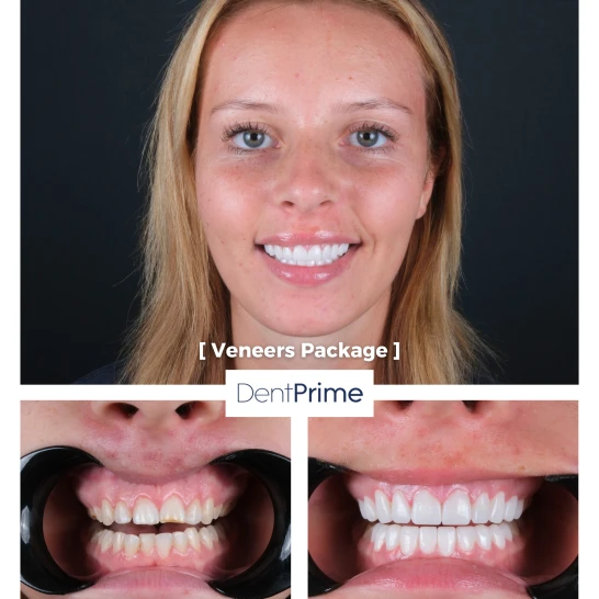 DentPrime before after case 12