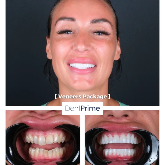 DentPrime before after case 2