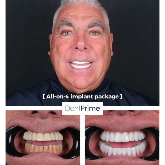DentPrime before after case 3