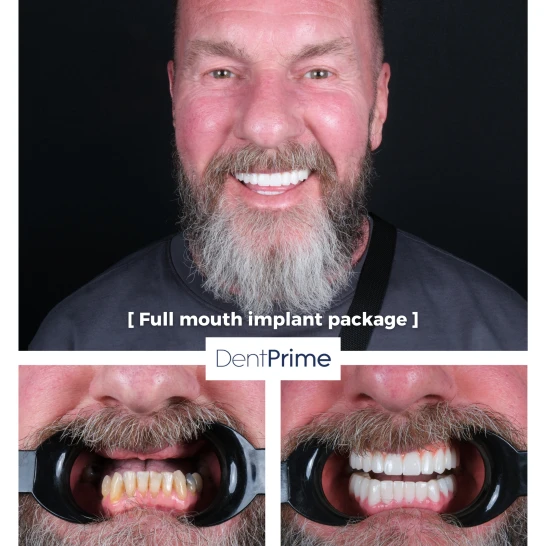 DentPrime before after case 4
