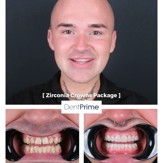 DentPrime before after case 5