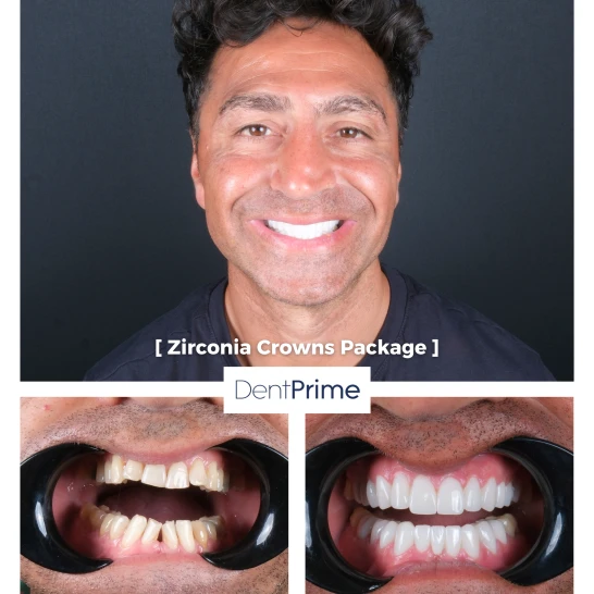 DentPrime before after case 6