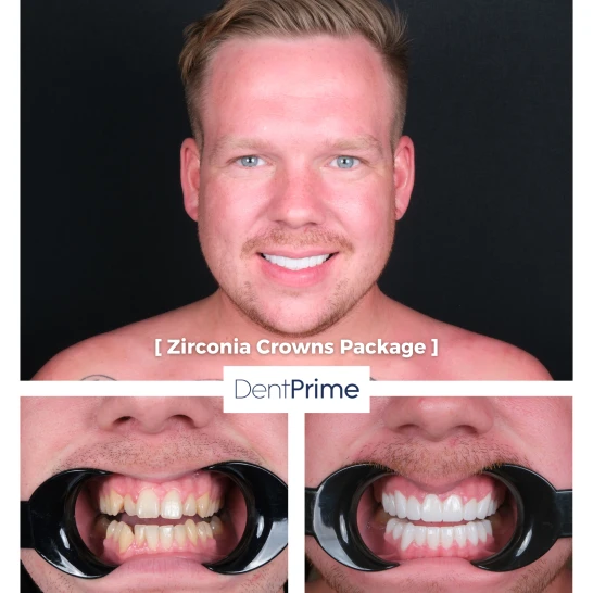DentPrime before after case 7
