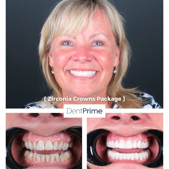 DentPrime before after case 8