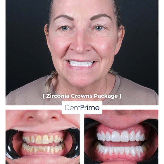 DentPrime before after case 9